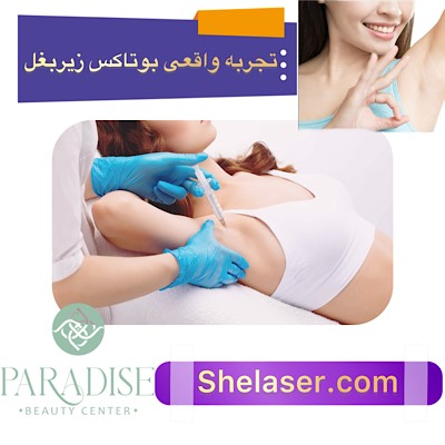 تجربه واقعی بوتاکس زیر بغل