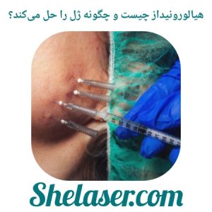هیالورونیداز چیست و چگونه ژل را حل می‌کند؟