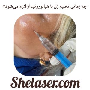 چه زمانی تخلیه ژل با هیالورونیداز لازم می‌شود؟