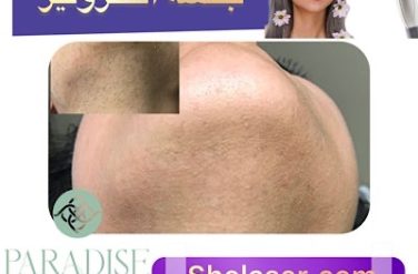 جلسه الکترولیز
