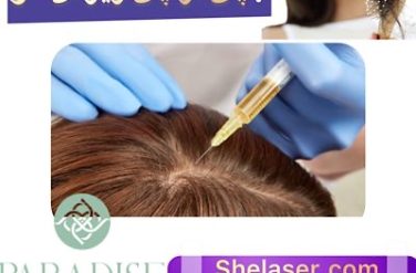 پی آر پی ریزش مو